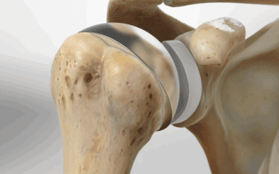 Non-surgical Alternatives to Joint Replacement: Ultimate Guide