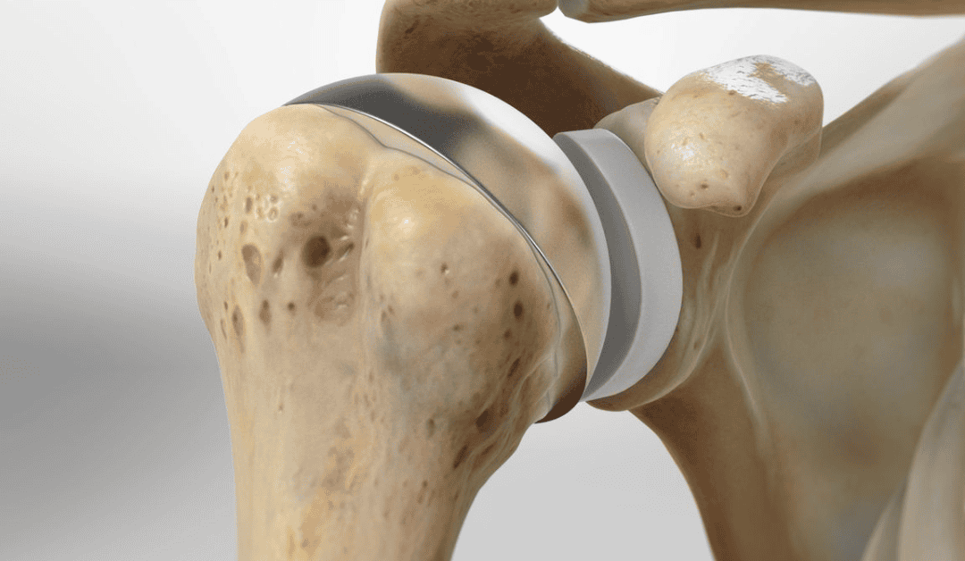 non surgical Non-surgical alternatives to joint replacement